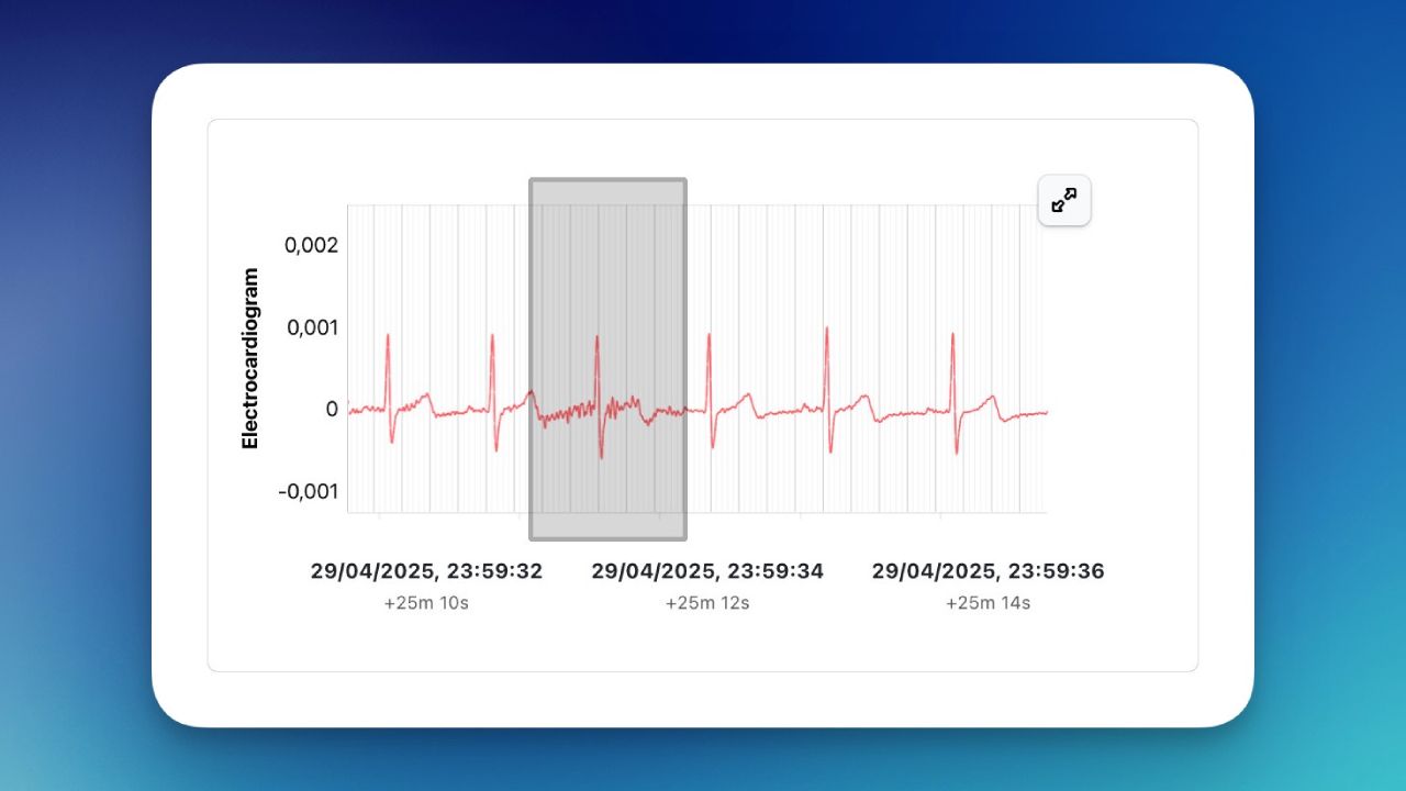 ECG artifact handling