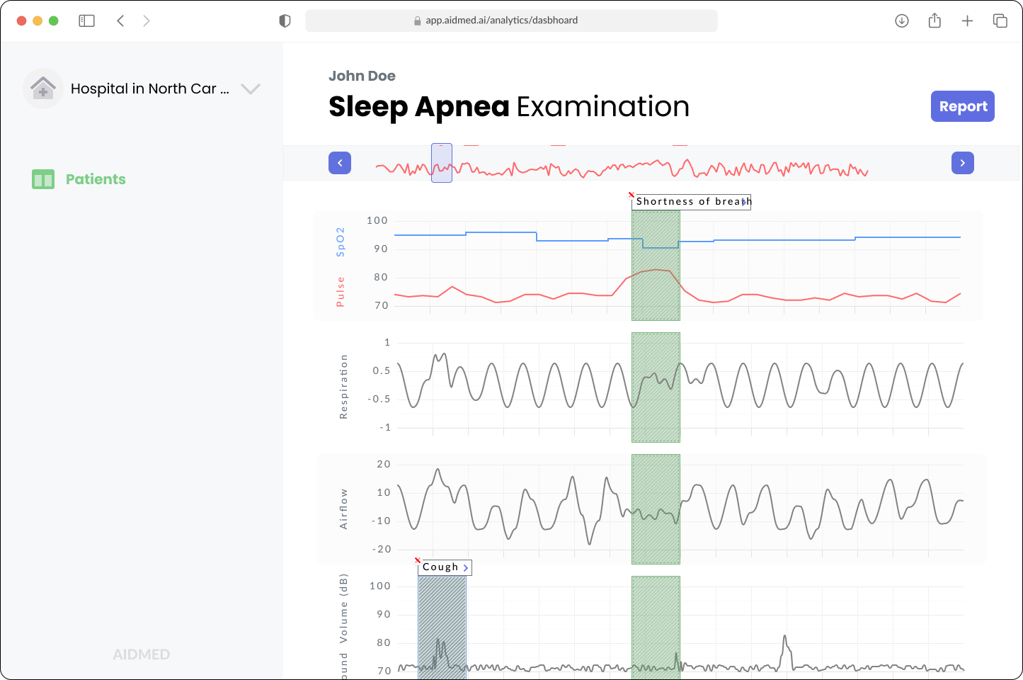 Example of obstructive sleep apnea examination