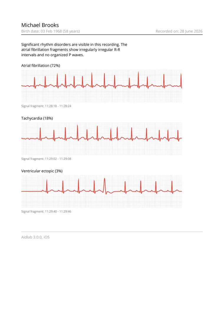 Sample ECG PDF report preview with rhythm annotation