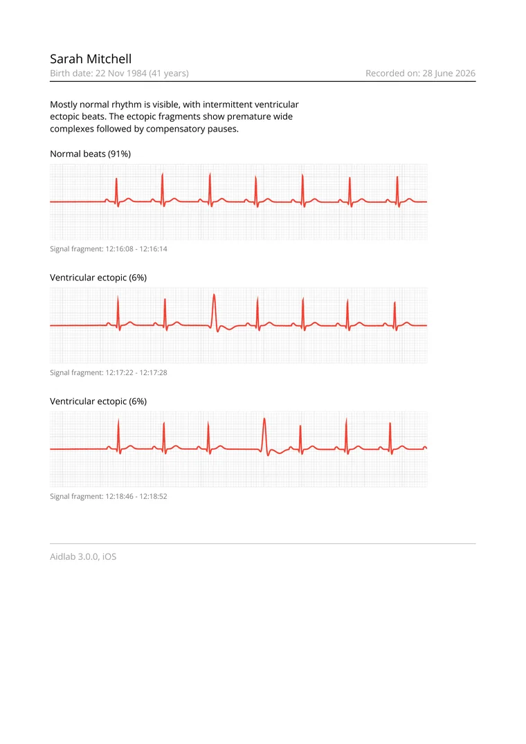 Sample ECG PDF report preview with event notes