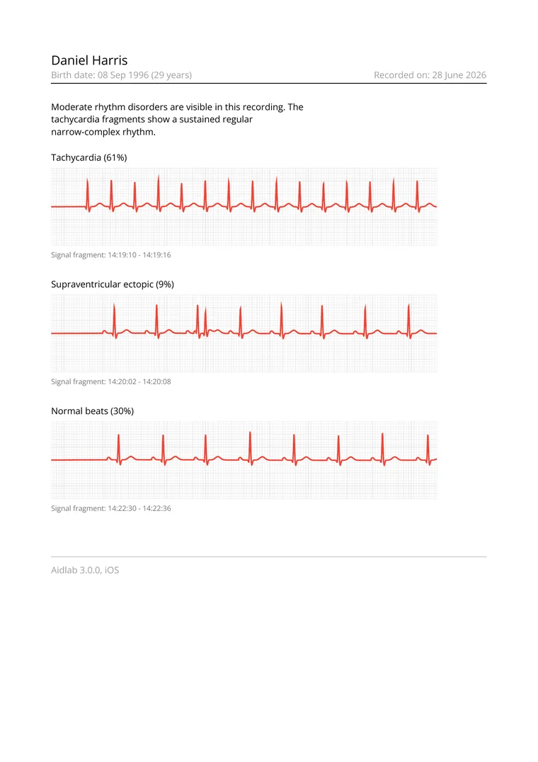Sample ECG PDF report preview with timeline details